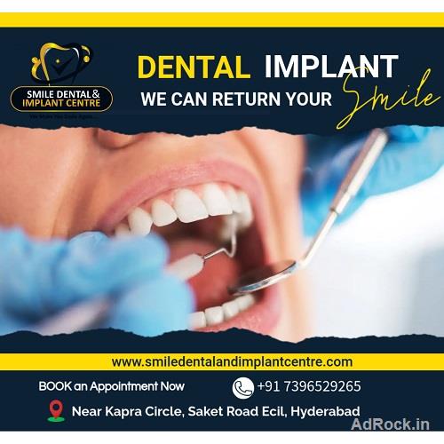 Dental Implant Cost in Hyderabad 2026 | Smile Dental and Implant Centre