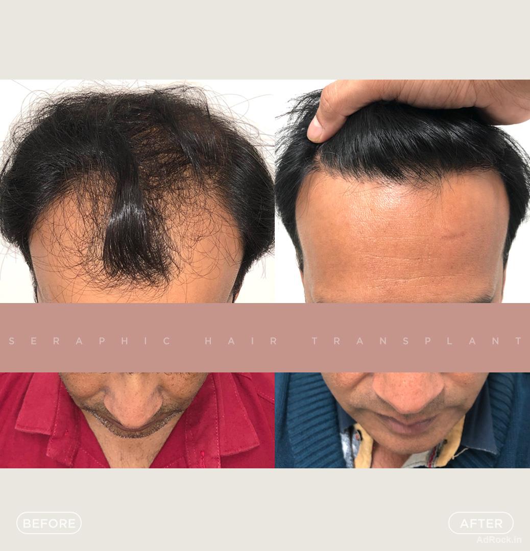 Best Hair Transplant Indore – Natural, Safe & Affordable Hair Restoration
