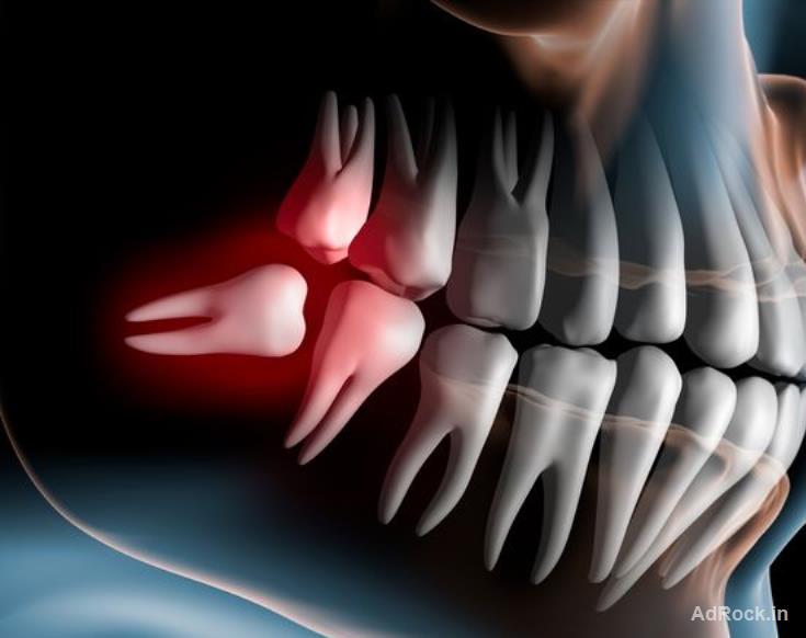 Wisdom Teeth Extraction Cost near A. S. Rao Nagar, Secunderabad