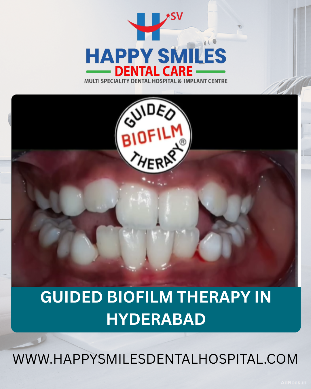 Affordable Guided Biofilm Therapy Cost in Hyderabad | Advanced Dental Cleaning Solutions
