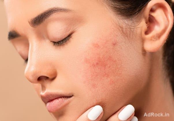 Say Goodbye to Acne with FMS Skin & Hair in Hyderabad