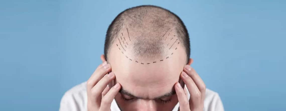 Hair Transplant